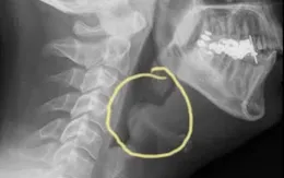 Đột ngột đau họng, khó nuốt - nói, khó thở: Coi chừng viêm thanh thiệt