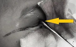 Vấp ngã, bé trai 5 tuổi bị thanh sắt đâm xuyên mắt lên não
