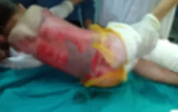 Tuyên Quang: Liên tiếp trẻ nhập viện do bỏng nước sôi