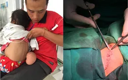 Cắt bỏ khối u đeo bám 4 năm cho bé gái người dân tộc Mông