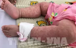 UNICEF: Dịch sởi là mối đe dọa nghiêm trọng đối với trẻ em