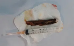 Ngã vào bờ rào, nam thanh niên bị cành củi dài gần 10cm đâm vào hốc mắt