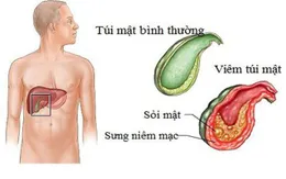 Những biến chứng nguy hiểm của sỏi mật