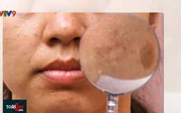 Cảnh báo nám da ở thai phụ trong thời điểm nắng nóng