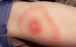 Vết quầng đỏ - dấu hiệu nhận biết của bệnh Lyme