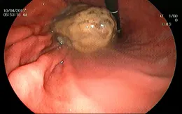 Thường xuyên dùng bột nghệ nấu canh, cụ bà nhập viện vì khối bã thức ăn trong dạ dày