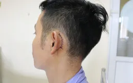 Thủng màng nhĩ vì điện thoại phát nổ khi đang sạc