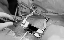 Bệnh viện quận đầu tiên trên cả nước thực hiện mổ tim ít xâm lấn