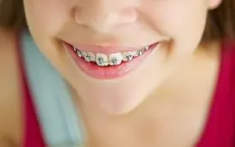 Nguy hiểm khi niềng răng sai cách