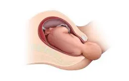 Kỹ thuật mới cứu sản phụ bị biến chứng sau sinh