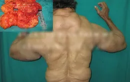 Người đàn ông có thân hình đồ sộ như lực sĩ vì... u mỡ