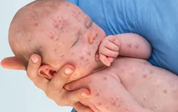 WHO: Bệnh sởi bùng phát ở quy mô mạnh nhất trong lịch sử nhân loại