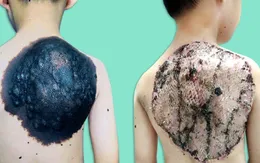 Phẫu thuật u hắc tố khổng lồ vùng lưng hiếm gặp ở bé trai 7 tuổi