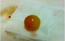Nguy hiểm: Trẻ nuốt phải hạt nở