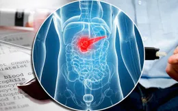 Phát hiện "gót chân Achilles" của bệnh ung thư tuyến tuỵ