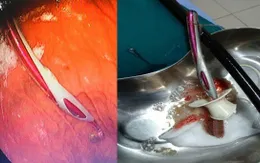 Hy hữu: lấy bàn chải đánh răng hơn 20cm trong dạ dày cô gái trẻ