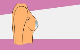 Túi độn ngực có vỡ khi đi máy bay?