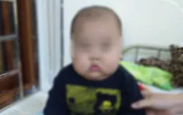 Bé trai bị phù mặt, suy thận do uống thuốc không theo đơn