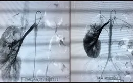 Kịp thời nút mạch cầm máu cứu người phụ nữ vỡ thận do tai nạn giao thông