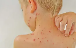 Bỏ túi cách ngừa bệnh dị ứng gây phiền toái mùa đông