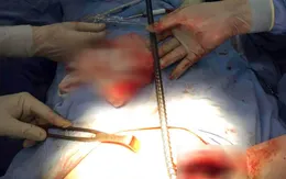 Nam công nhân nhập viện với thanh sắt dài 65cm đâm xuyên ngực