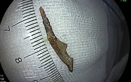 Mảnh xương dài 3cm "lẩn trốn" trong ruột thừa người đàn ông
