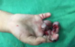 Bé trai 4 tuổi dập đốt tay vì kẹt vào máy ép mía
