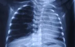 Cứu sống bé sơ sinh bị dị dạng đường dẫn khí phổi nhờ chẩn đoán trước sinh