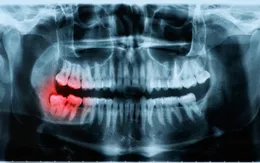 Cảnh báo phơi nhiễm phóng xạ khi chụp X-quang điều trị nha khoa