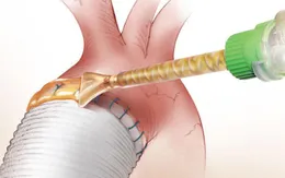 Trung Quốc phát triển keo sinh học để làm lành vết thương
