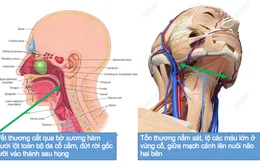 Sập giàn giáo, người phụ nữ phụ hồ bị xe rùa cắt gần đứt cổ