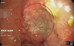 Đau thượng vị uống thuốc không khỏi, đi khám phát hiện ung thư dạ dày