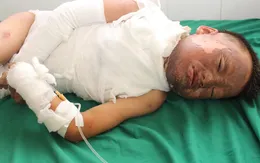 Bé trai 10 tuổi người Mông bị bỏng cần được giúp đỡ