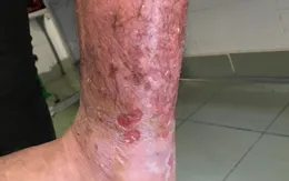 Tá hỏa nhập viện sau khi tự đắp lá để xương gãy mau lành