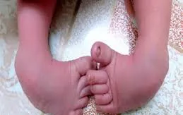Khám sàng lọc cho trẻ mắc tật cơ xương khớp và sẹo bỏng tại Cần Thơ