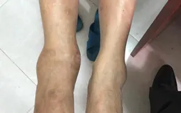 Bó lá nhà thầy lang trị gãy xương: Ngậm ngùi chịu di chứng
