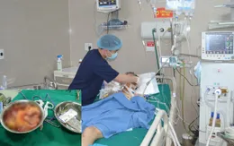 Cắt 1m ruột cấp cứu người đàn ông bị tai nạn giao thông