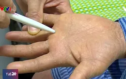 Sai lầm trong điều trị bệnh vảy nến có nguy cơ mắc ung thư da?