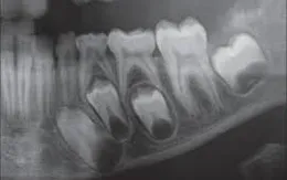 Chớ chủ quan với các bệnh lý về răng