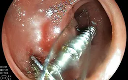 Nuốt đinh vít, bé 20 tháng phải nhập viện cấp cứu