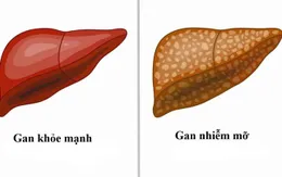 Cẩn trọng với bệnh gan nhiễm mỡ