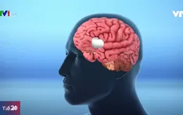 Phẫu thuật não để cai nghiện ma túy