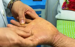 Những điều cần biết về bệnh viêm khớp vảy nến