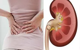 Ăn thế nào để phòng sỏi thận?