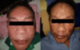 Người đàn ông nguy kịch do dị ứng thuốc