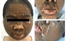 Viêm da tiếp xúc nặng do bôi thuốc không rõ nguồn gốc