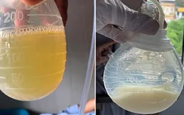 Dịch rò hàng lít từ cổ bệnh nhân ung thư tuyến giáp