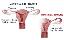 Phẫu thuật kịp thời một ca chửa kẽ hy hữu