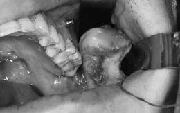 Nam thanh niên bị lệch mặt do khối u xương hàm