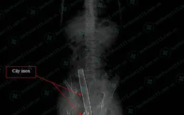 Ngã trên cao xuống, nam thanh niên bị cọc phơi đồ đâm xuyên người